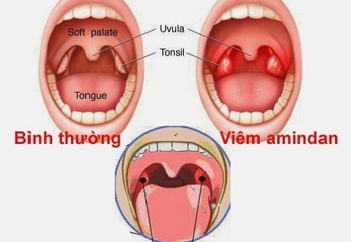 Triệu chứng bị viêm amidan có thể xảy ra ở mọi lứa tuổi