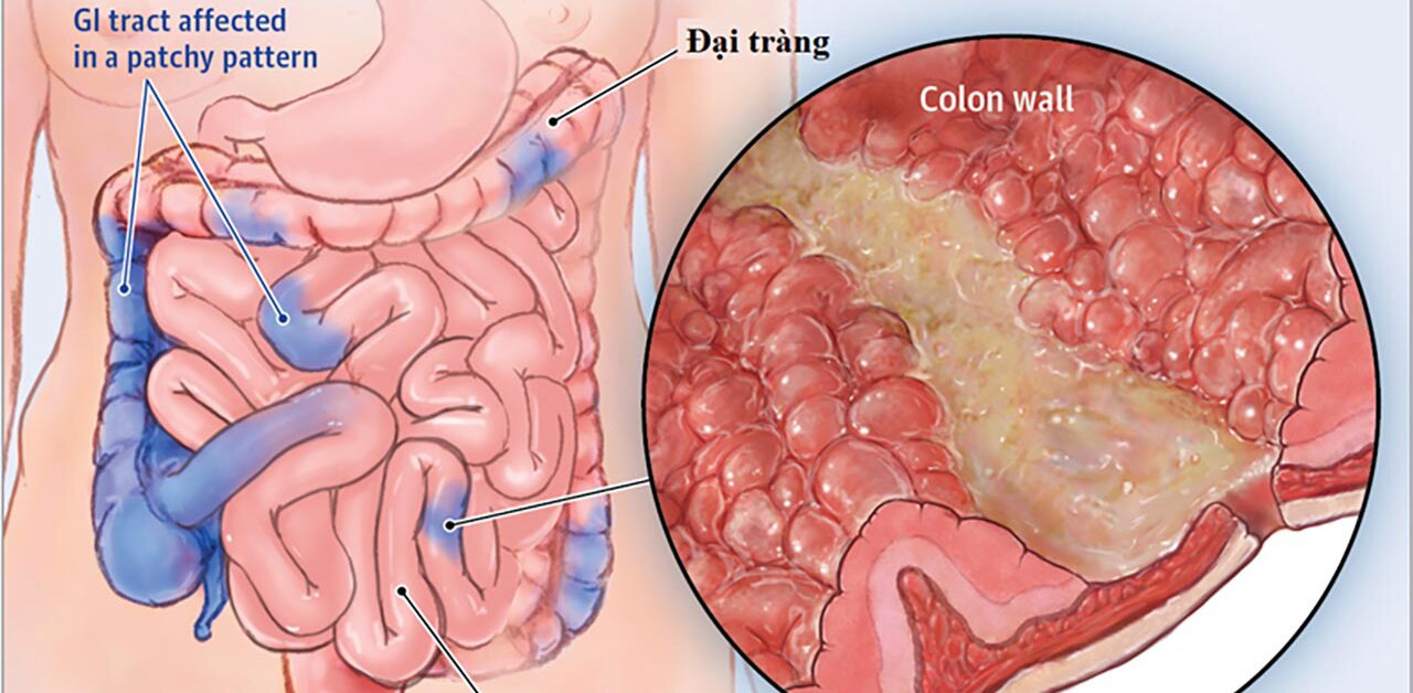 Triệu chứng cần biết của bệnh viêm ruột Crohn