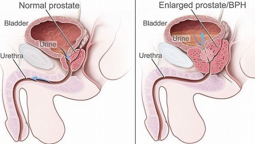 Triệu chứng cảnh báo u xơ tuyến tiền liệt
