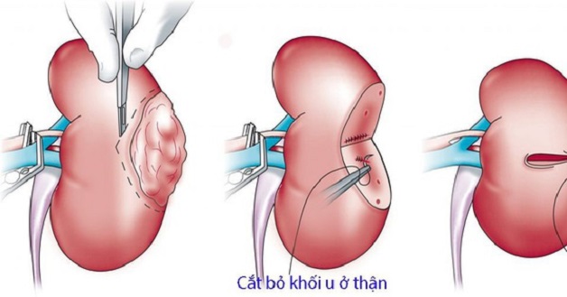 Triệu chứng của bệnh ung thư thận