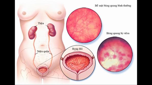 Triệu chứng của bệnh viêm bàng quang