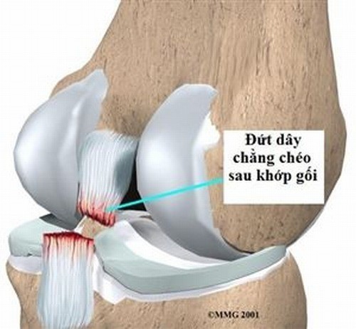 Triệu chứng của đứt dây chằng khớp gối