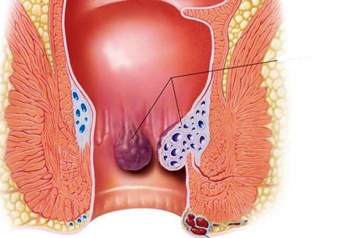 Triệu chứng của polyp hậu môn