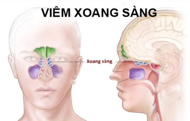 Triệu chứng của viêm xoang sàng sau là gì? Đừng bỏ qua!