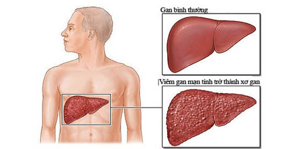 Triệu chứng của xơ gan giai đoạn mất bù