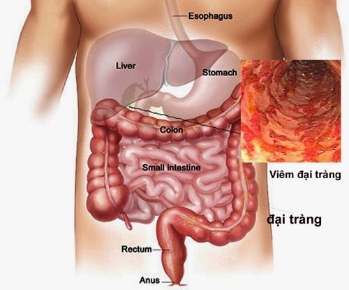 Triệu chứng đau đại tràng có xu hướng tăng nhanh