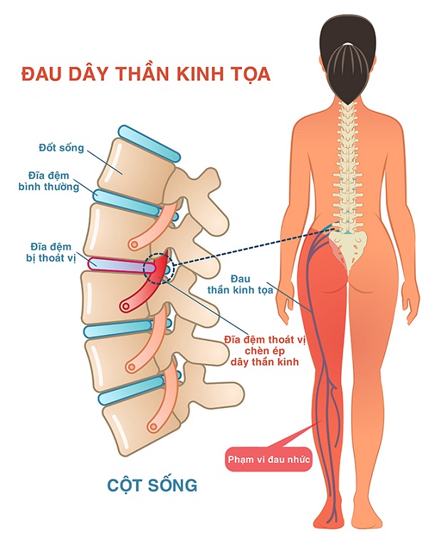 Triệu chứng đau rễ dây thần kinh tọa