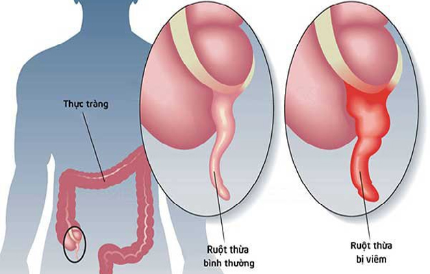 Triệu chứng đau ruột thừa bạn cần chú ý