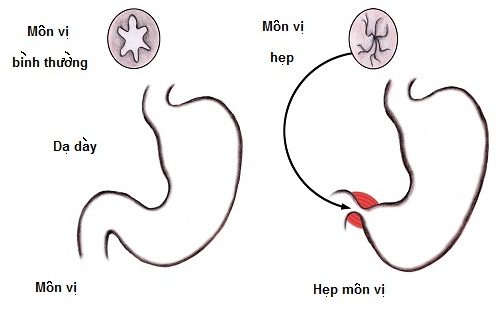 Triệu chứng hẹp môn vị