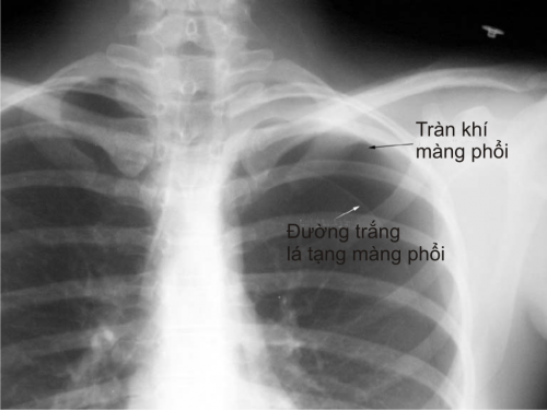 Triệu chứng khi bị tràn dịch màng phổi