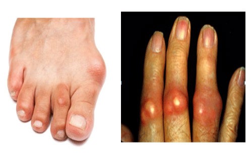 Triệu chứng nào cảnh báo bệnh Gout