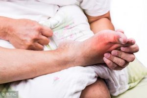 Triệu chứng nào cảnh báo bệnh Gout