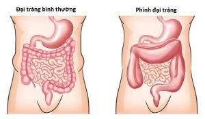 Triệu chứng phình đại tràng ở trẻ sơ sinh