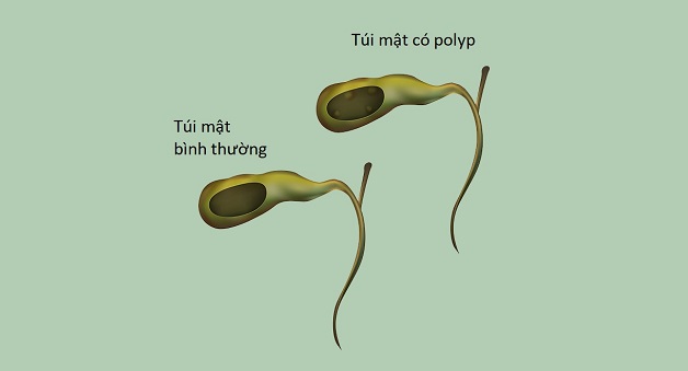 Triệu chứng polyp túi mật và cách điều trị hiệu quả