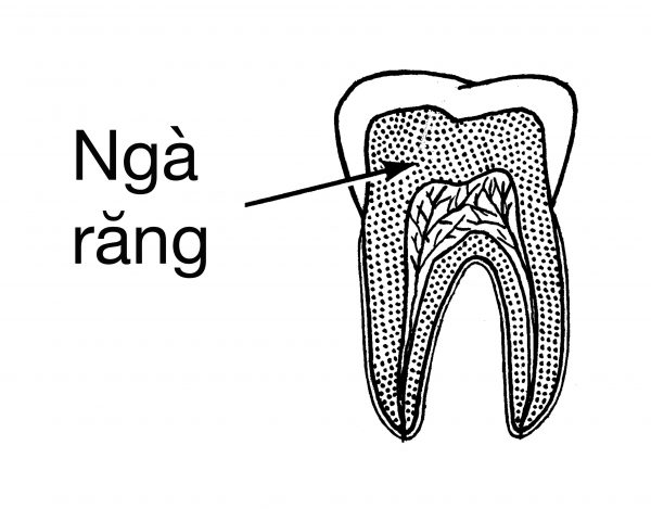 Triệu chứng răng nhạy cảm là gì? Làm sao để khắc phục tình trạng này?