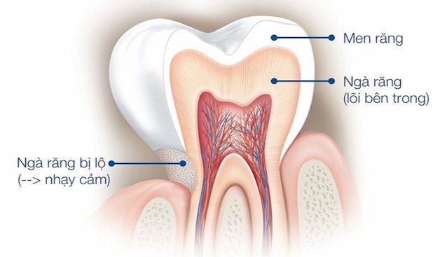 Triệu chứng răng nhạy cảm, nguyên nhân và cách ngừa bệnh