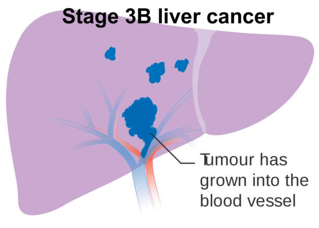 Triệu chứng u gan ác tính giai đoạn 3 và cách điều trị