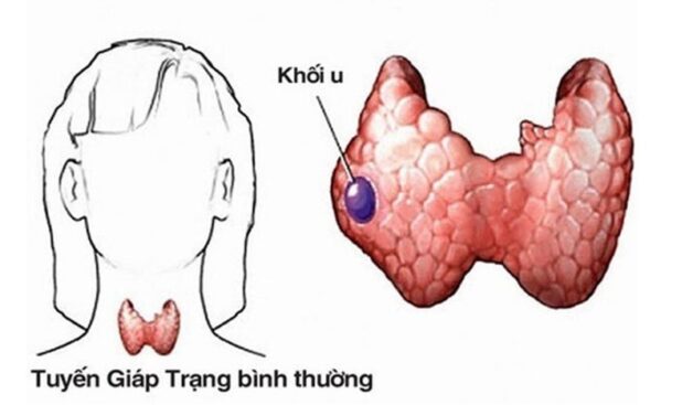 Triệu chứng u tuyến giáp lành tính là gì?