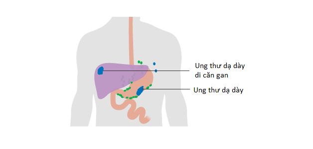 Triệu chứng ung thư dạ dày giai đoạn cuối