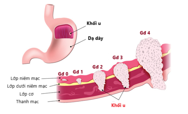 Triệu chứng ung thư dạ dày ở giai đoạn đầu chớ bỏ qua