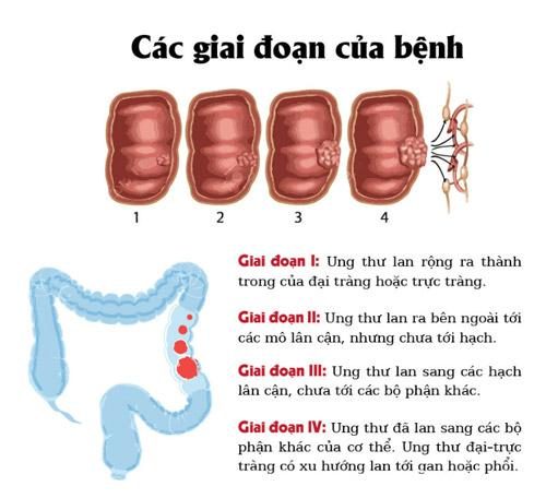 Triệu chứng ung thư đại tràng