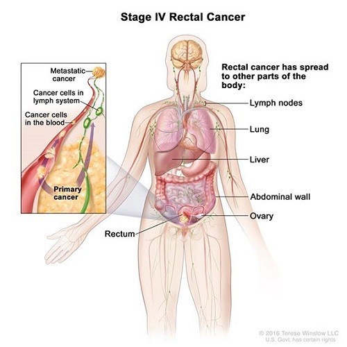 Triệu chứng ung thư trực tràng giai đoạn cuối