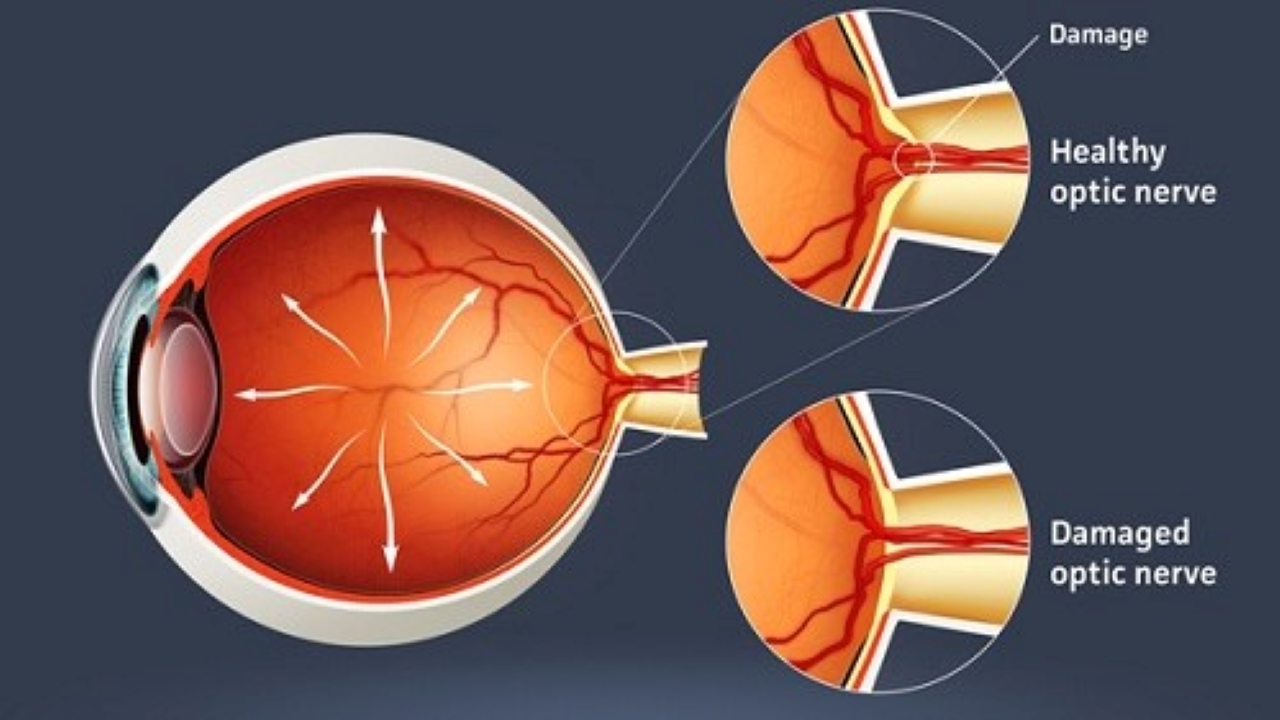 Triệu chứng và cách điều trị bệnh Glaucoma góc đóng