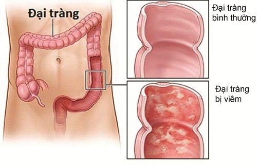 Triệu chứng viêm đại tràng – bạn cần biết