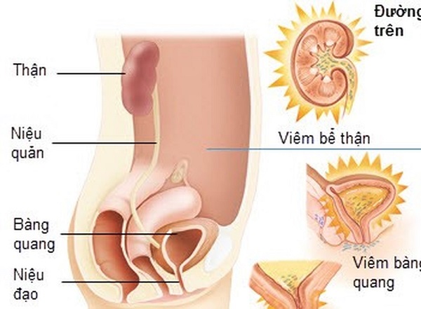 Triệu chứng viêm đường tiết niệu là gì?