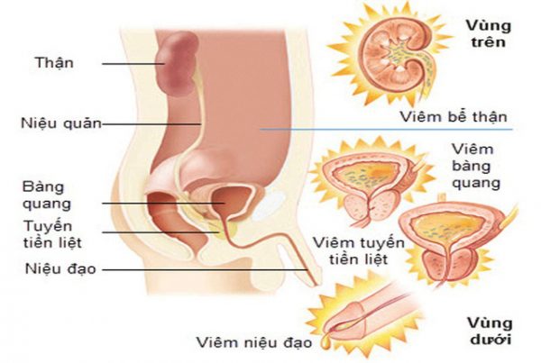 Triệu chứng viêm đường tiết niệu ở nam giới, cách xử lý