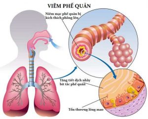 Triệu chứng viêm phế quản cấp khó khăn trong điều trị