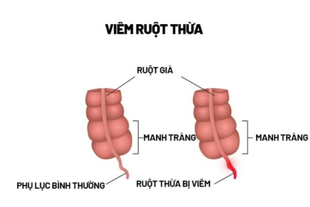 Triệu chứng viêm ruột thừa cấp là gì?