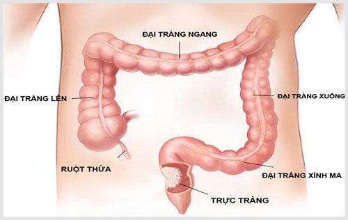 Triệu chứng viêm trực tràng