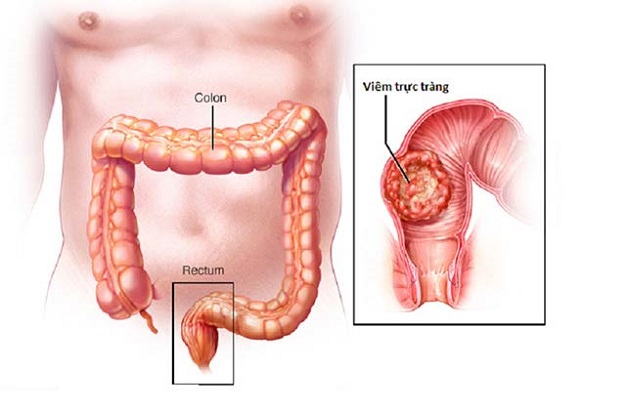 Triệu chứng viêm trực tràng