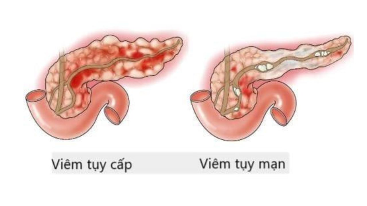 Triệu chứng viêm tụy mạn và những điều quan trọng cần nhớ