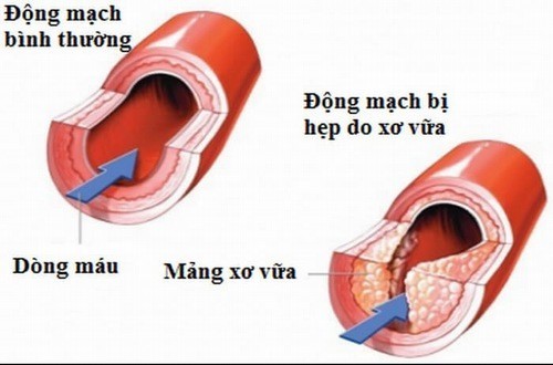 Triệu chứng xơ vữa động mạch là gì?