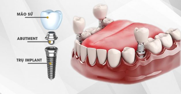 Trồng răng bằng cấy ghép implant là gì?