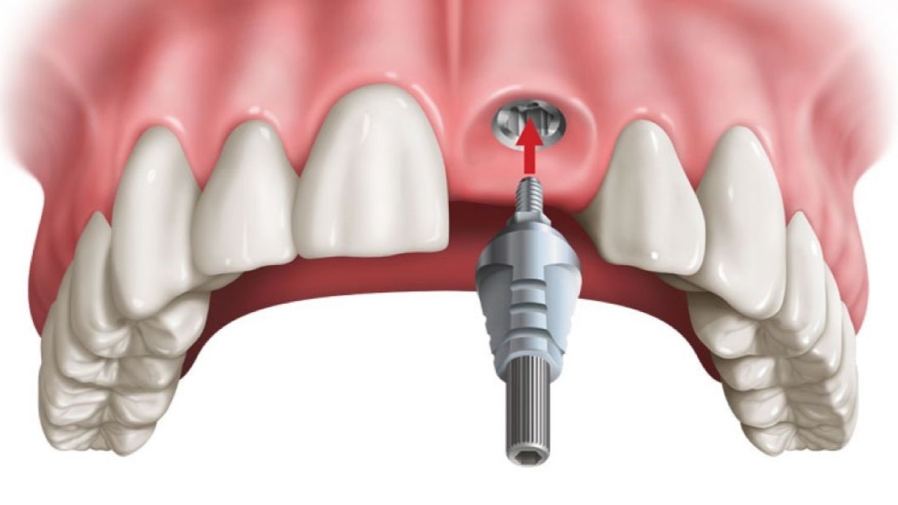 Trồng răng cửa có đau không và những trường hợp cần thực hiện