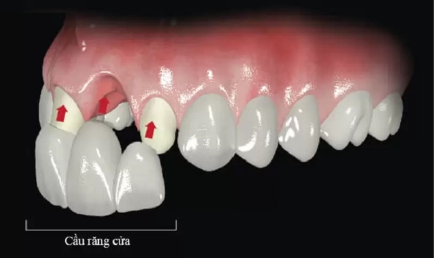 Trồng răng cửa có đau không và những trường hợp cần thực hiện