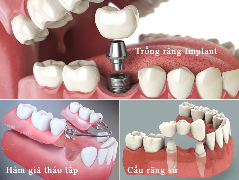 Trồng răng giá rẻ và những điều cần lưu ý 