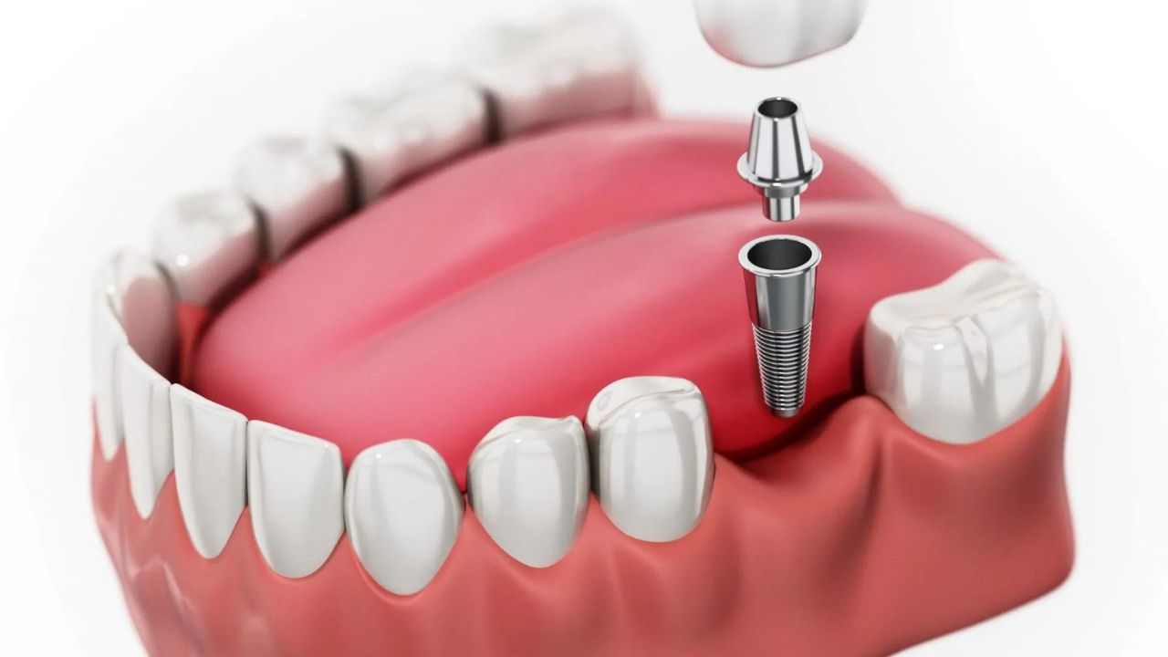 Trồng răng implant bao nhiêu tiền: Chi phí và điều cần biết