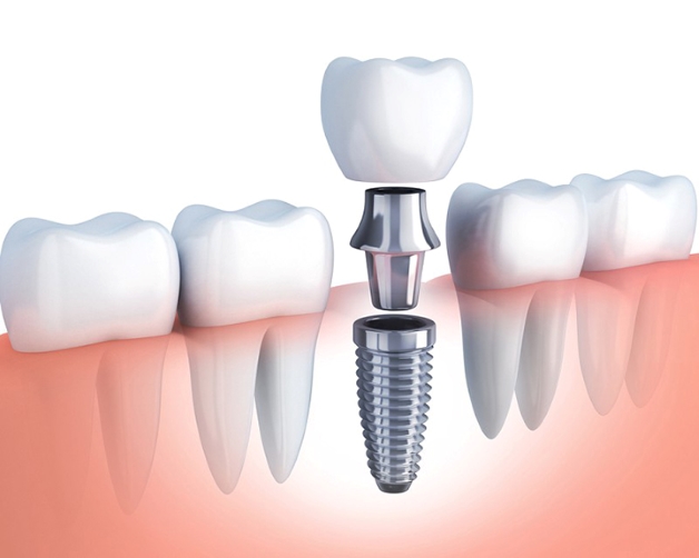 Trồng răng Implant bao nhiêu tiền và những yếu tố tác động