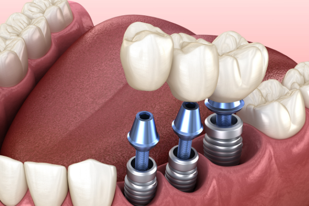 Trồng răng Implant bao nhiêu tiền và những yếu tố tác động