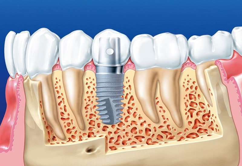 Trồng răng sứ – Giải pháp để hàm răng hoàn hảo