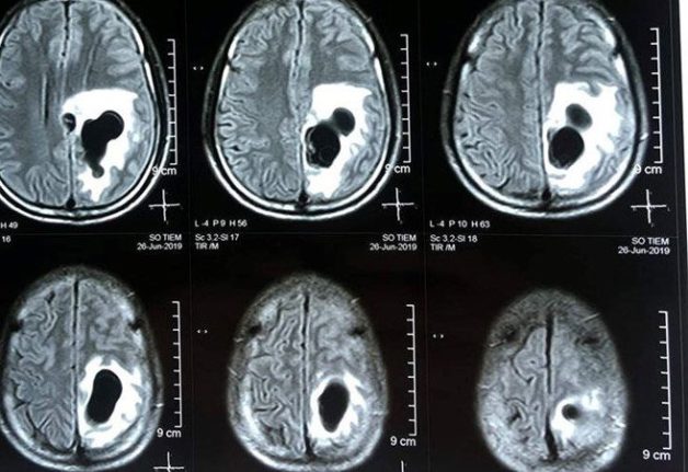 Trường hợp nào cần chỉ định chụp MRI sọ não?