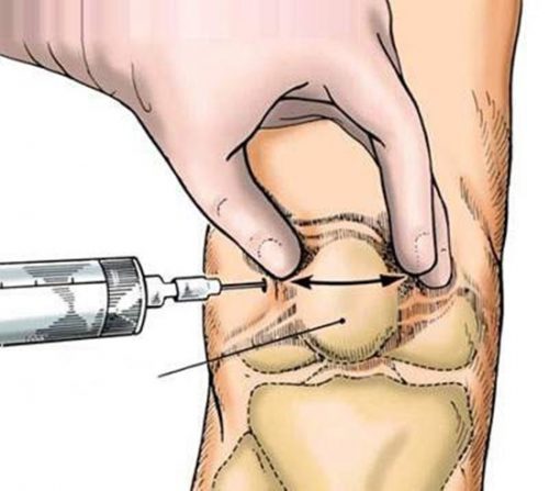 Trường hợp nào có thể chọc dò khớp gối?