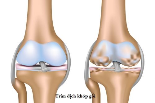 Trường hợp nào có thể chọc dò khớp gối?