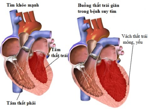 Từ A đến Z bệnh suy tim tổn thương tim nghiêm trọng