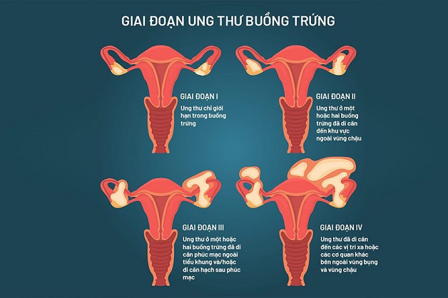 Từ A – Z về căn bệnh ung thư buồng trứng