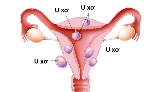 Tử cung có nhân xơ gây nguy hiểm như thế nào?